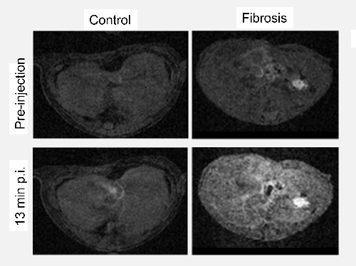 Image: In mice with liver fibrosis a bright MRI image of fibrotic regions is seen just 13 minutes after injection of SNIO-CBP contrast agent (Photo courtesy of Bawendi laboratory, MIT)